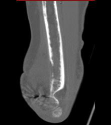 Humerus With Metastatic Disease to Bone- Lung Cancer - CTisus CT Scan