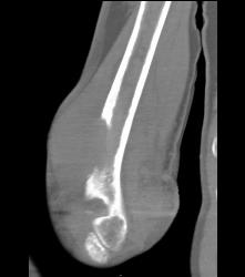 Humerus With Metastatic Disease to Bone- Lung Cancer - CTisus CT Scan