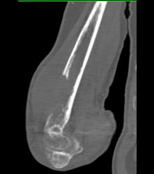 Humerus With Metastatic Disease to Bone- Lung Cancer - CTisus CT Scan