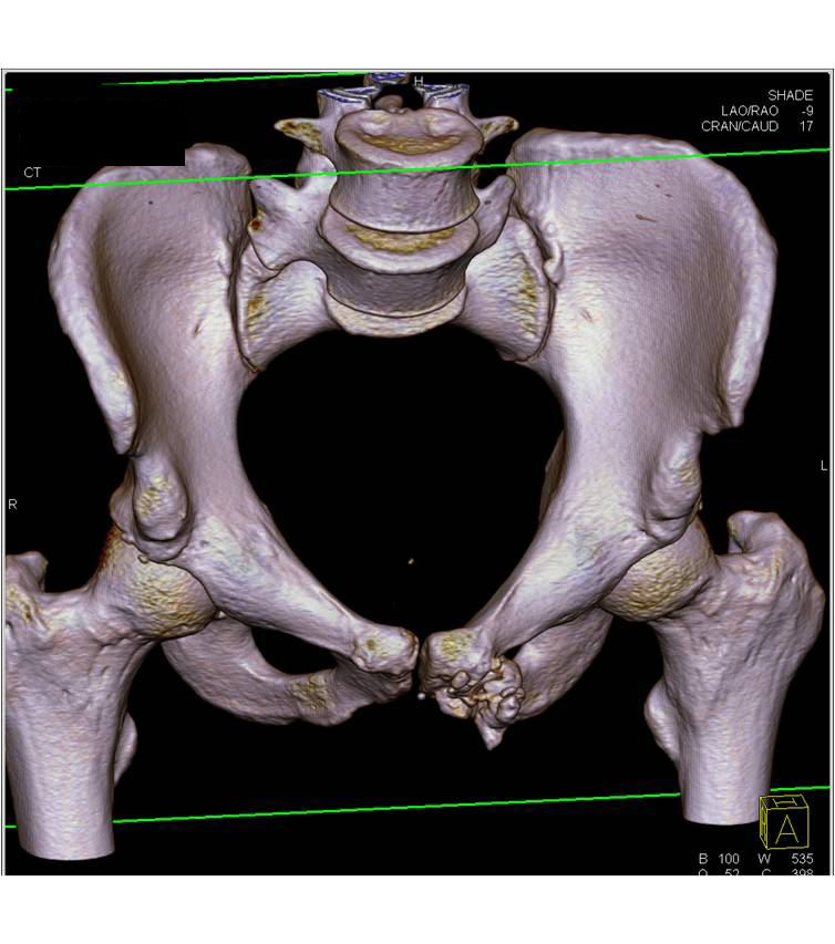 exostosis off the symphysis pubis in 3D - CTisus CT Scan