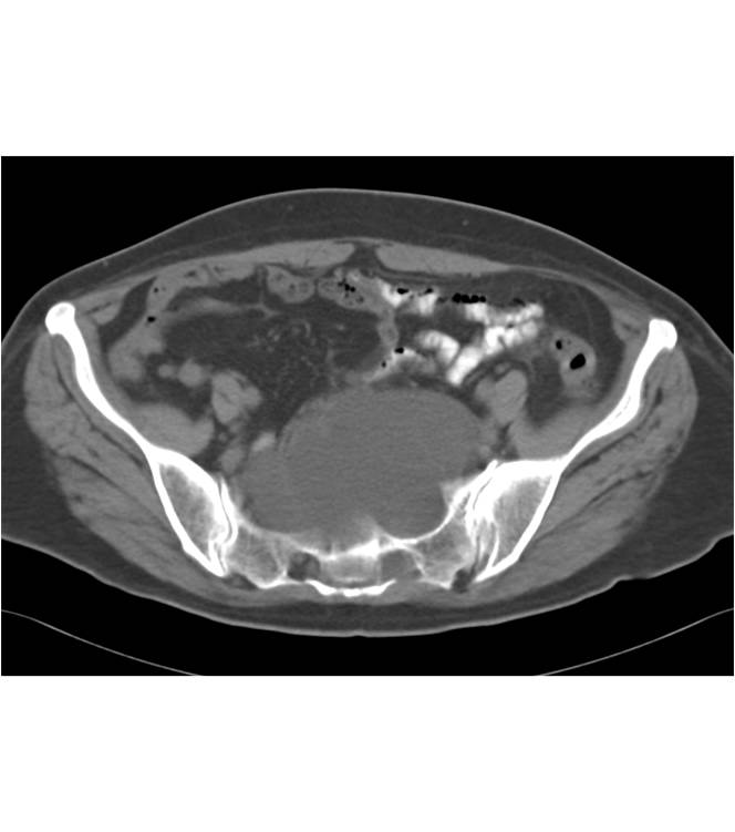 Dural Ectasia with Erosion of Sacral Foramina and 