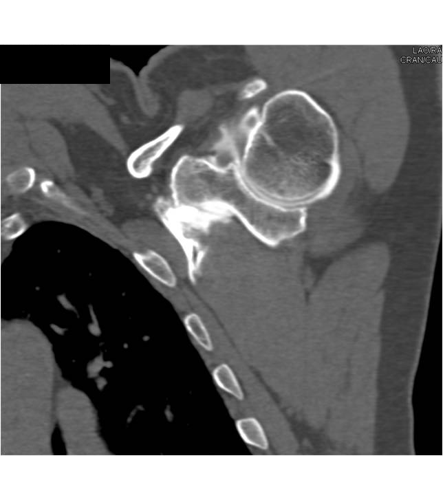 CT Arthrogram with Rotator Cuff Tear - CTisus CT Scan