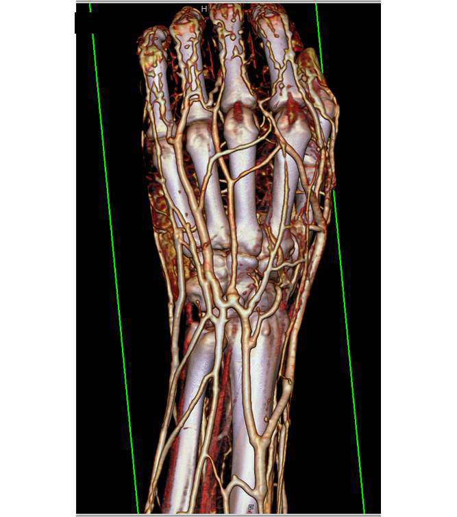 Volume Rendering of the Tissues of the Hand - CTisus CT Scan