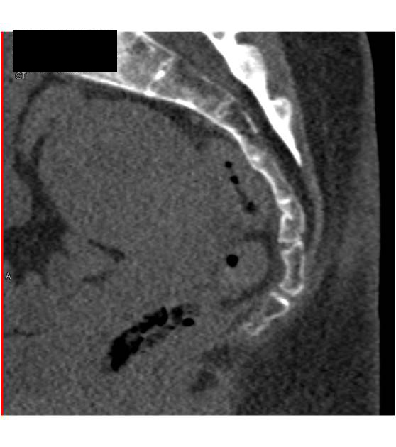 Coccyx Fractures - CTisus CT Scan
