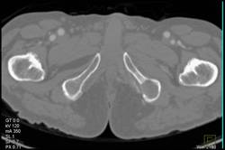 Metastatic Renal cell carcinoma - CTisus CT Scan