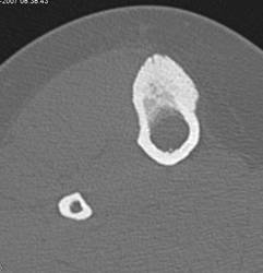 Osteoid Osteoma - CTisus CT Scan