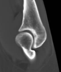 Trauma to Elbow - CTisus CT Scan