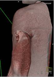 Stab Wound Shoulder with Muscle Injury but no Vascular Injury - CTisus CT Scan