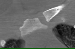 Posterior Dislocation of the Right Clavicle - CTisus CT Scan