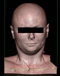 VRT Details of the Face - CTisus CT Scan