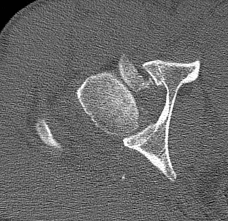 Complex Fenur Fracture and Dislocation with Dislocation Reduced but Femoral Head Components Rotated in Joint Space Nicely Defined with 3D Renderings for PRe-Op Planning - CTisus CT Scan