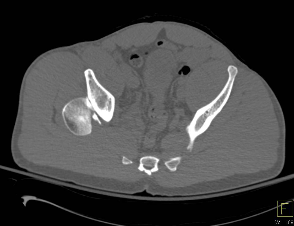 Hip Dislocation and Fracture in Multiple 3D Renderings with Bone Editing - CTisus CT Scan