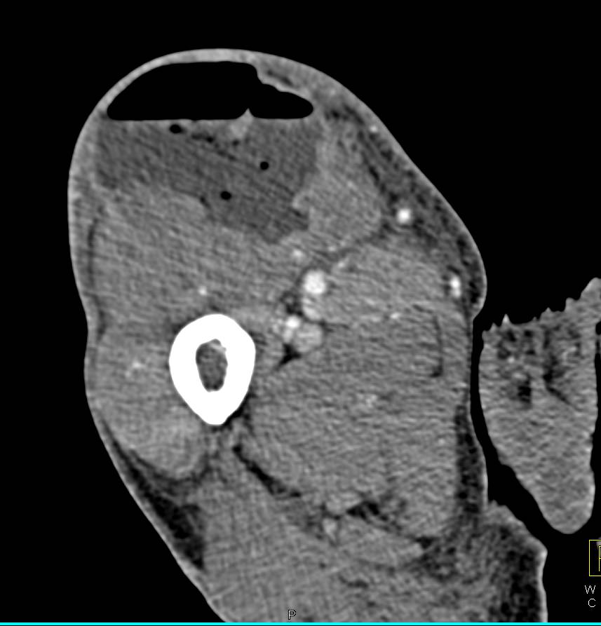 Intramuscular Abscess in Thigh with Air Fluid Level - CTisus CT Scan