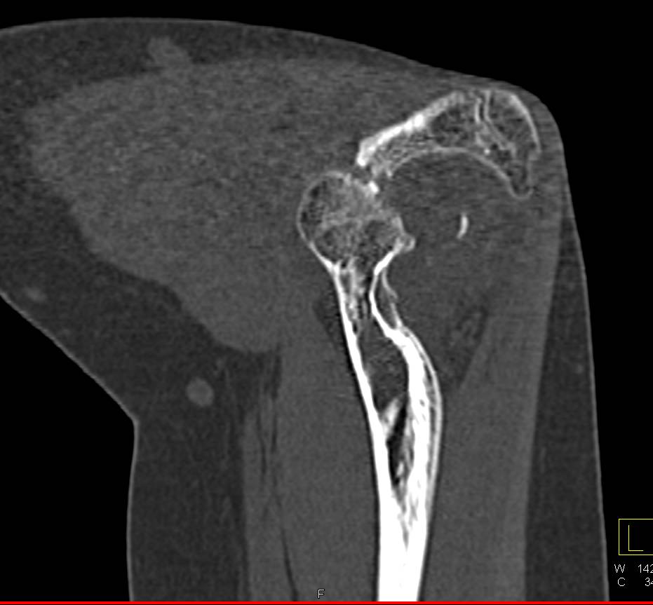 Prior Fracture Dislocation of the Elbow with Periosteal Reaction - CTisus CT Scan