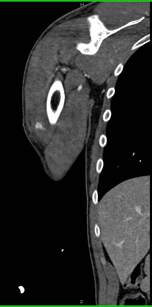 Stab Wound Right Shoulder with Active Bleed but no Evidence of Injury to Major Vessels - CTisus CT Scan