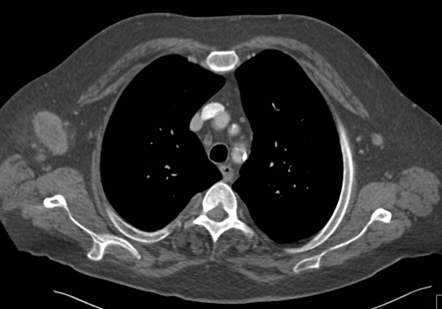 Axillary Nodes, Subcutaneous Nodules and Adrenal Metastases in a Patient with Lymphoma - CTisus CT Scan