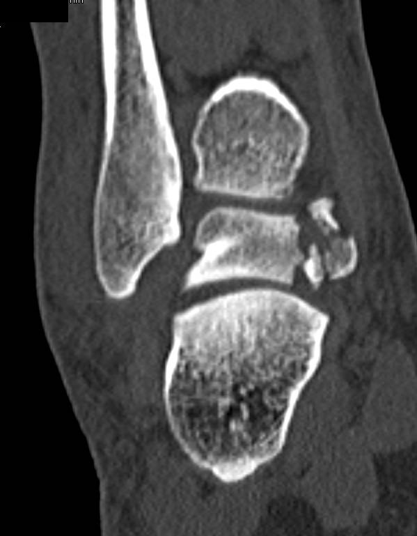 Talus Fracture in 3D - CTisus CT Scan