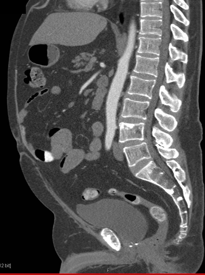 Blastic Bone Metastases from Prostate Cancer - CTisus CT Scan
