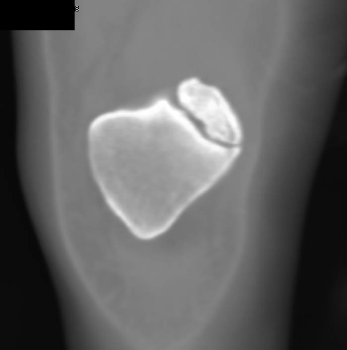 Bipartate Patella - CTisus CT Scan