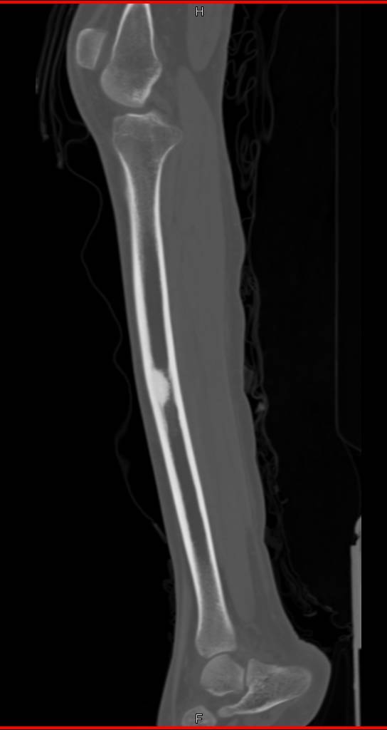 Benign Sclerotic Bone Lesion - CTisus CT Scan