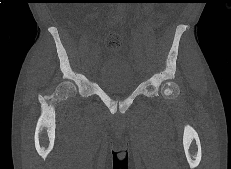 Renal Osteodystrophy - CTisus CT Scan