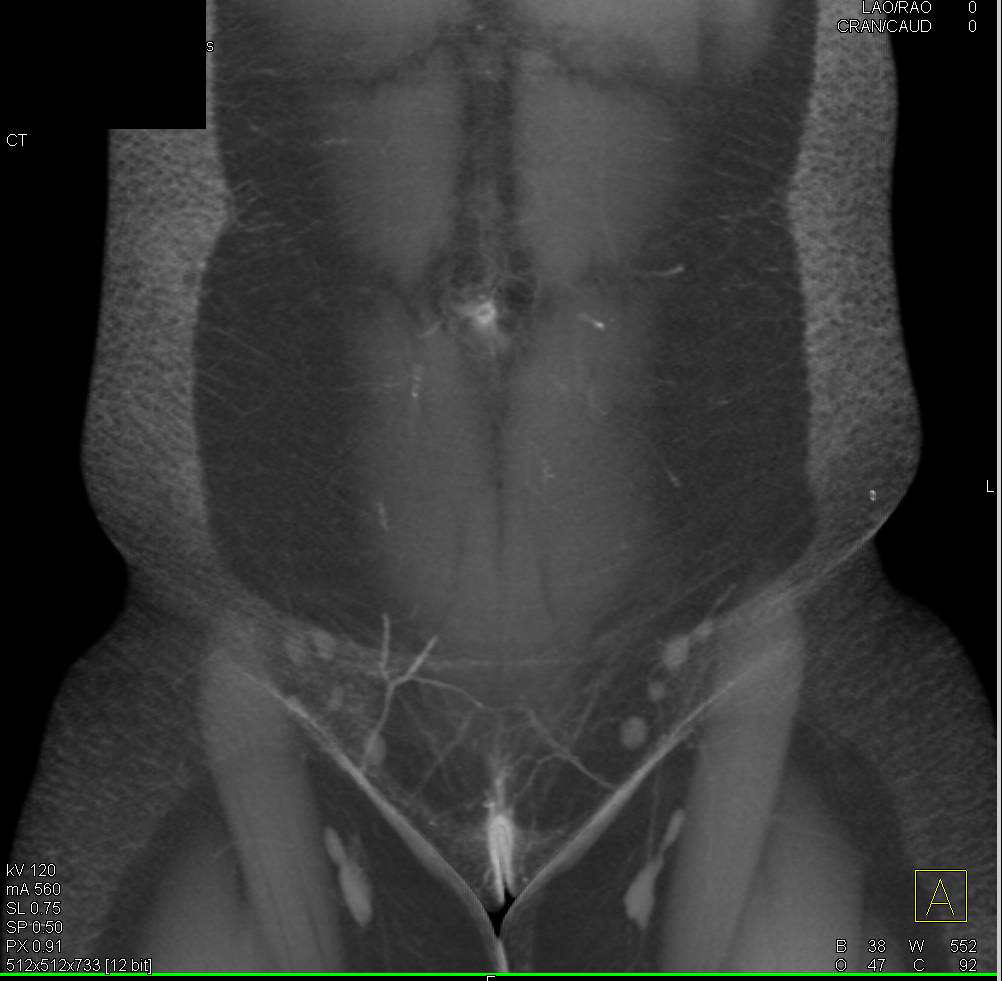 DIEP Flap Planning for Reconstructive Breast Surgery - CTisus CT Scan