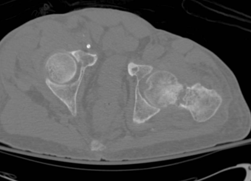 Left Femur Fracture in a Patient with Renal Osteodystrophy - CTisus CT Scan