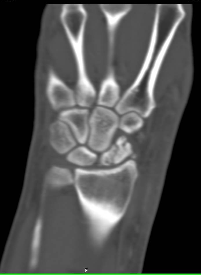 Nonunion Scaphoid Fracture as well as Soft Tissue Abscess - CTisus CT Scan