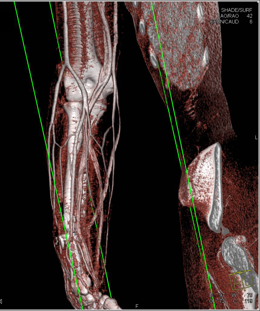 GSW with Fracture Forearm but no Vascular Injury - CTisus CT Scan