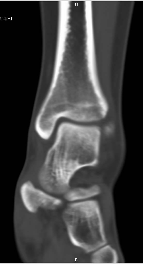 Subtle Talar Dome Fracture - CTisus CT Scan