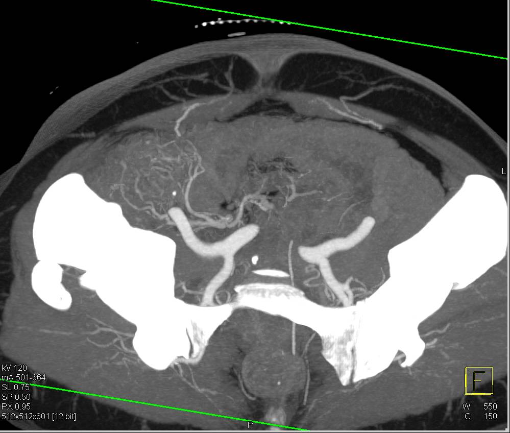DIEP Flap Planning for Reconstructive Breast Surgery - CTisus CT Scan