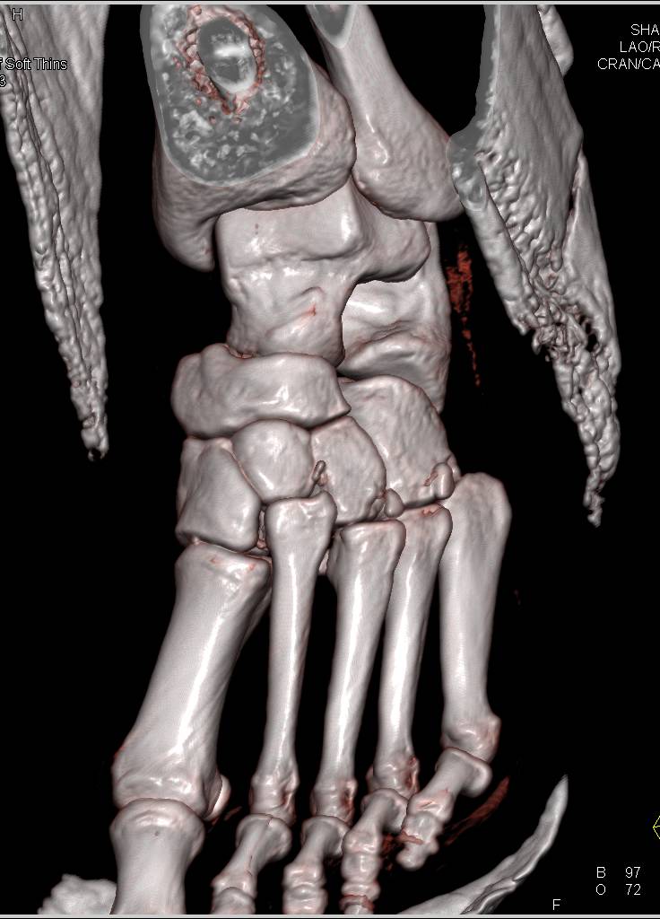 Lisfranc Injury - CTisus CT Scan