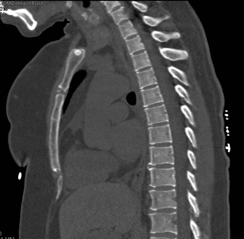 Osteoma in the Manubrium - CTisus CT Scan