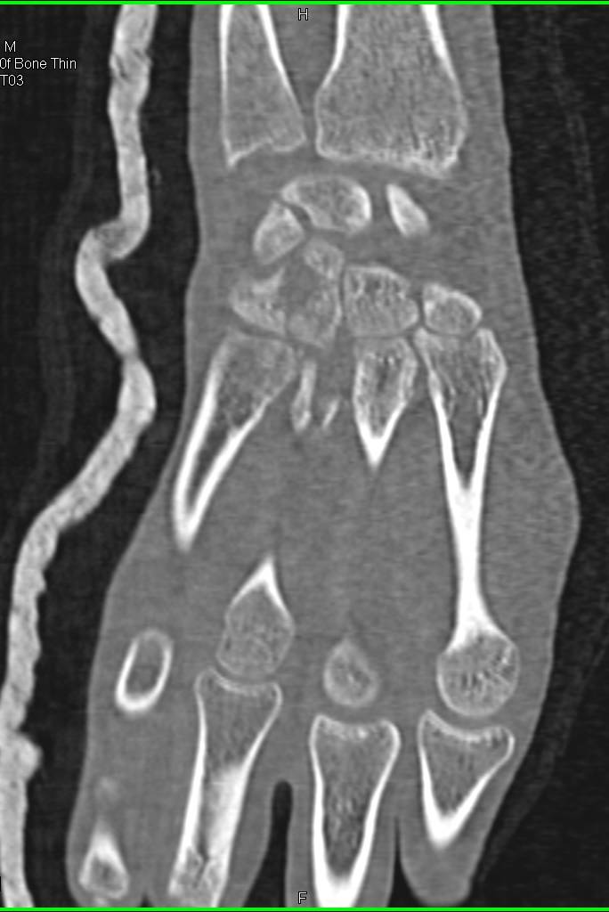Wrist Trauma with Multiple Fractures - CTisus CT Scan
