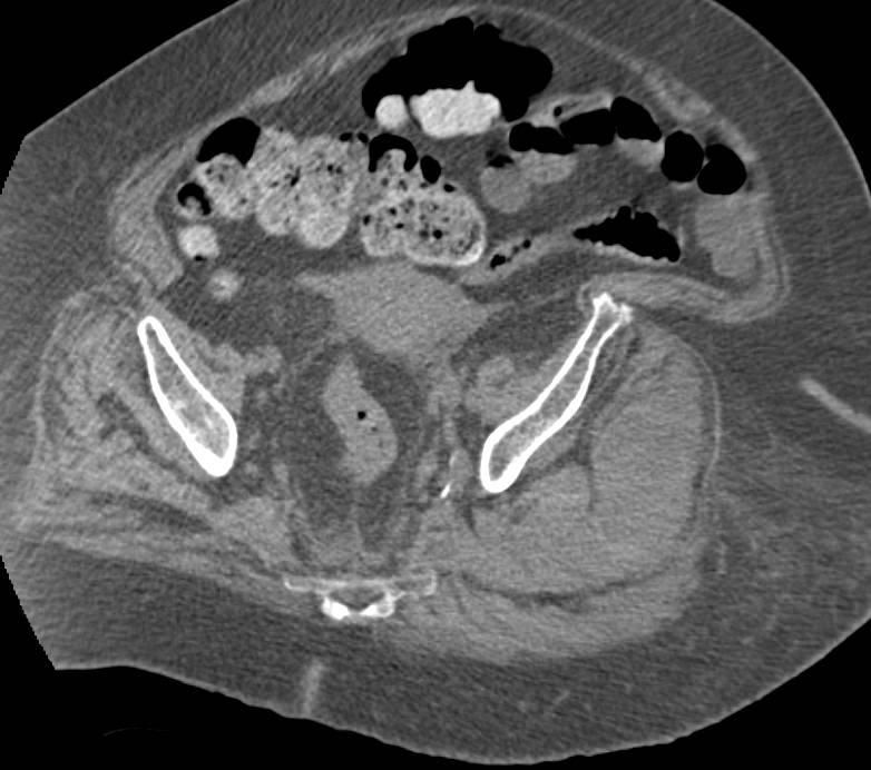 Hematoma in Left Gluteal Muscles - CTisus CT Scan