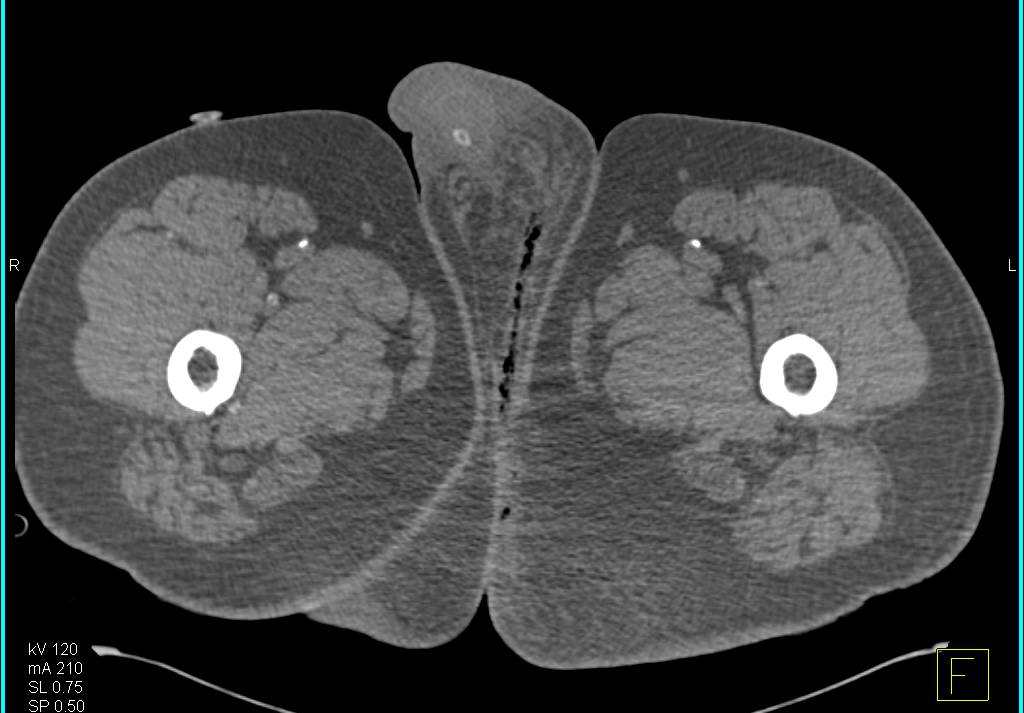 Necrotizing Fasciitis or Fournier's Gangrene - CTisus CT Scan