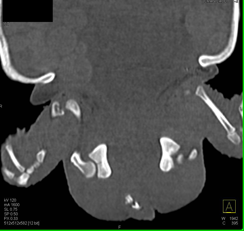 Hip Dysplasia - CTisus CT Scan