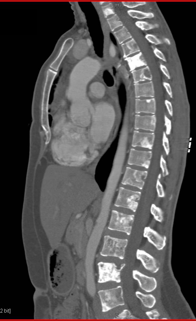 Blastic Bone Metastases Throughout the Spine and Pelvis - CTisus CT Scan