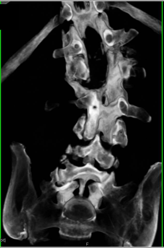 Failed Spinal Fusion - CTisus CT Scan