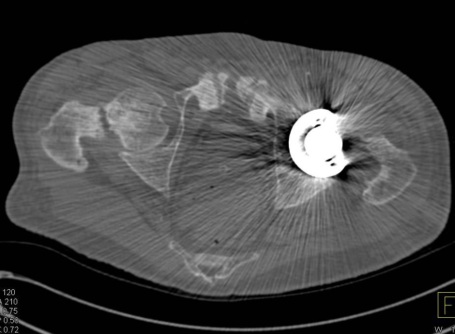 Renal Osteodystrophy with Erosion of Sacroiliac Joints (SI Joints) and Right Femoral Neck Fracture - CTisus CT Scan