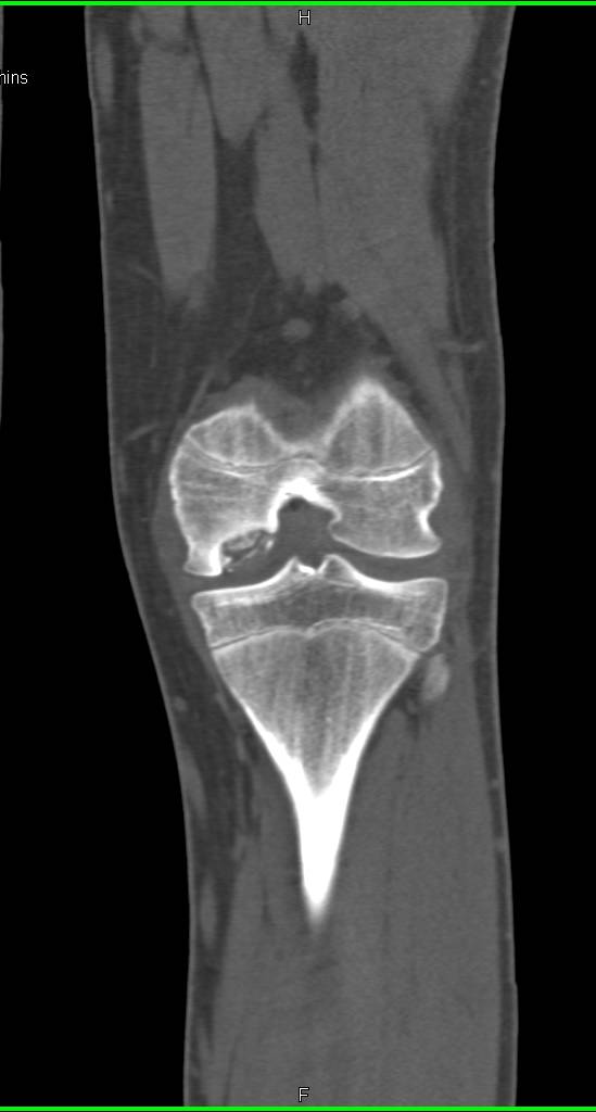 Avascular Necrosis of Medial Femoral Condyle - CTisus CT Scan