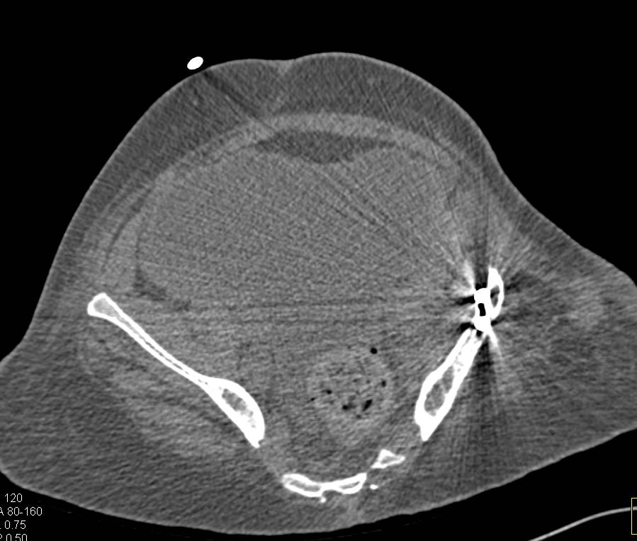Dysplastic Hip with Reconstruction and Neobladder with CT Cystogram - CTisus CT Scan