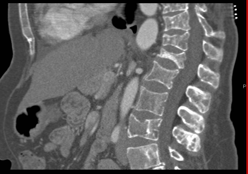 Metastatic Breast Cancer to Bone - CTisus CT Scan
