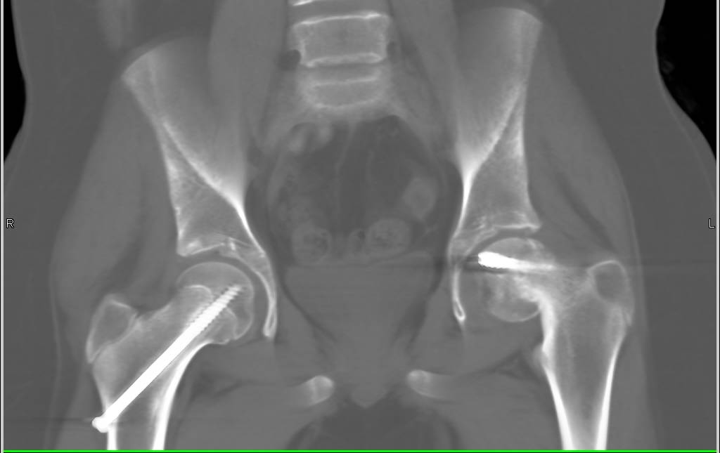 SCFE (Slipped Capital Femoral Epiphysis) with Failed Pinning of Left Hip - CTisus CT Scan