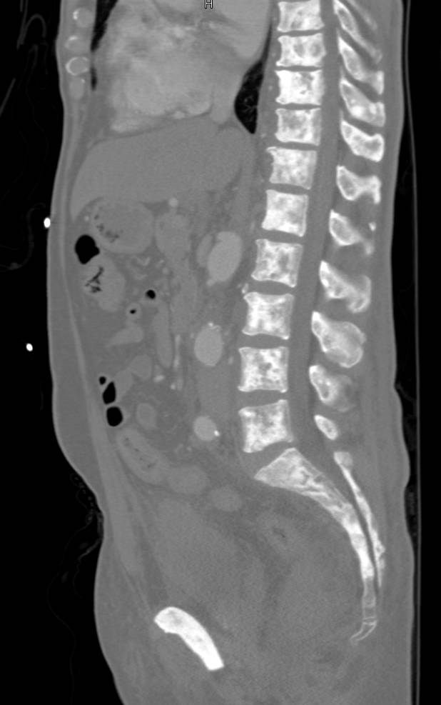 Extensive Blastic Metastases from Carcinoid Tumor - CTisus CT Scan
