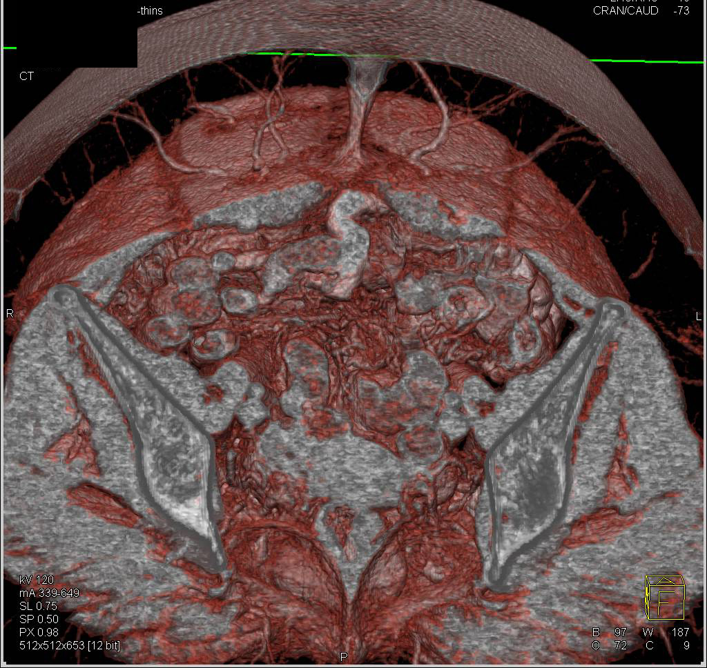 DIEP Flap Planning for Perforators - CTisus CT Scan