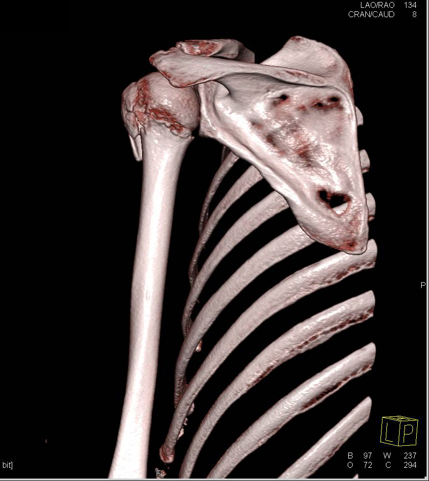 Impacted Humerus Fracture - CTisus CT Scan