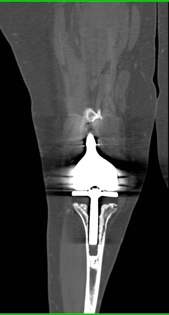 3D Display of a Total Knee Replacement - CTisus CT Scan