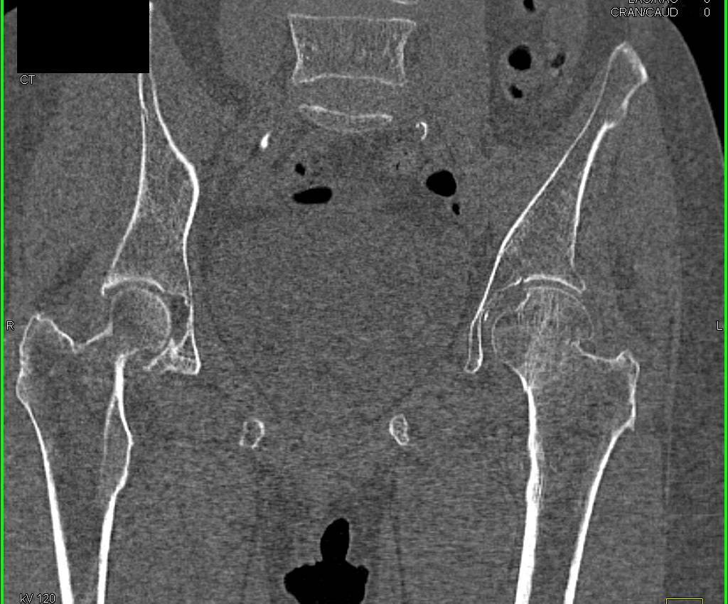 Subtle Impacted Fracture Left Femoral Neck - CTisus CT Scan
