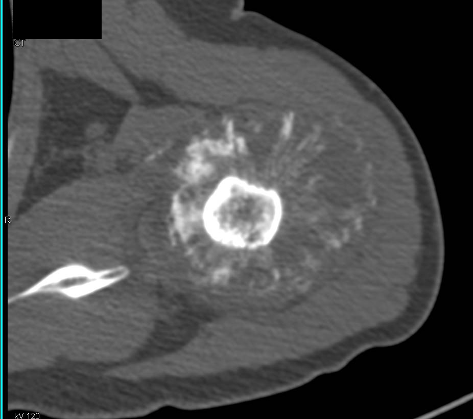 Osteosarcoma of the Humerus - CTisus CT Scan